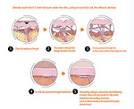 Liposonix – aparat pentru slabit HIFU