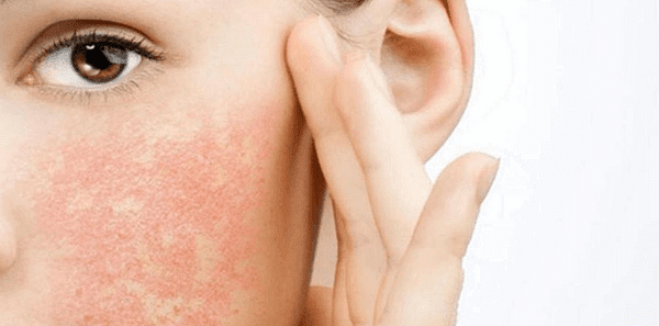 Алергия по лицето. Симптоми и лечение.