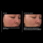 Ретинолова терапия за чувствителна кожа PCA Skin Sensitive R-ON Retinol Treatment