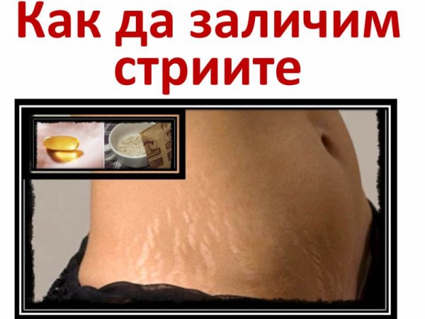 Как да заличим стрии по тялото?!