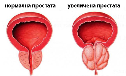 viermii pot provoca prostatita este dureros să verifici prostatita