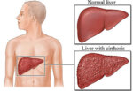 Цироза на черния дроб